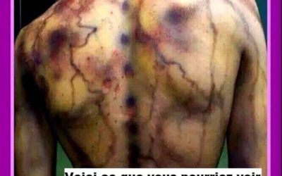 Vivre avec la fibromyalgie